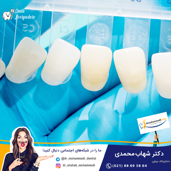 هر واحد دندان یعنی چه و چه تاثیری در قیمت ونیر دندان دارد؟