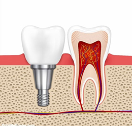 ایمپلنت دندانی چیست؟ - کلینیک دندانپزشکی دکتر شهاب محمدی