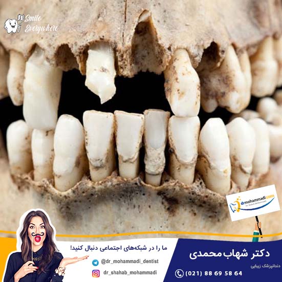 ایمپلنت در دوران باستان - کلینیک دندانپزشکی دکتر شهاب محمدی