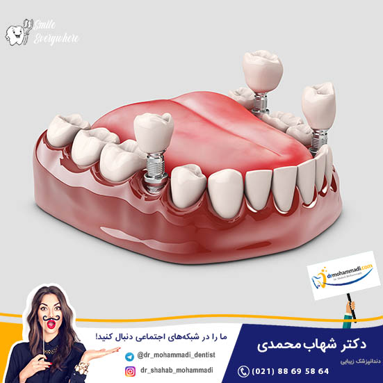 بهترین زمان برای انجام ایمپلنت چه زمانی است؟ - کلینیک دندانپزشکی دکتر شهاب محمدی