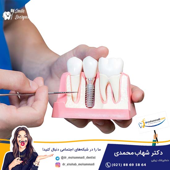 تحول در کاشت ایمپلنت از گذشته تا امروز - کلینیک دندانپزشکی دکتر شهاب محمدی