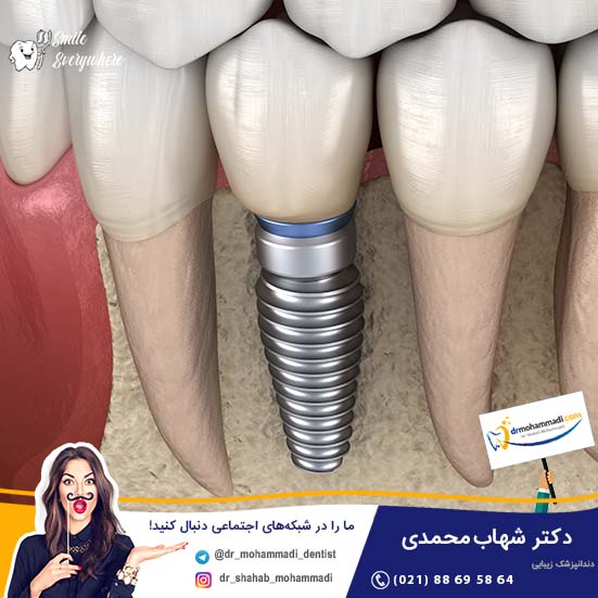 آیا جراحی ایمپلنت درد دارد؟ - کلینیک دندانپزشکی دکتر شهاب محمدی