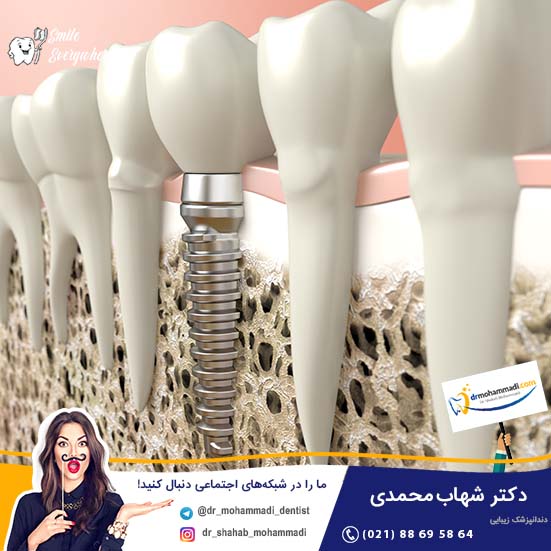 تاثیر محل قرارگیری ایمپلنت در تحلیل رفتن استخوان - کلینیک دندانپزشکی دکتر شهاب محمدی