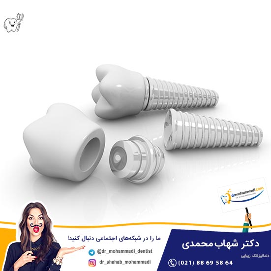 ایمپلنت کوتاه در مقایسه با ایمپلنت های بلندتر تر در فک خلفی عمودی تقویت شده - کلینیک دندانپزشکی دکتر شهاب محمدی