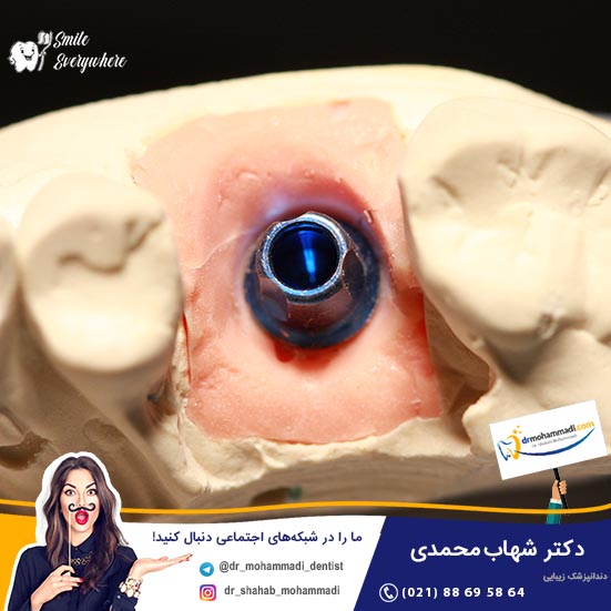 چرا فرآیند کاشت ایمپلنت دندان بسیار طولانی است؟ - کلینیک دندانپزشکی دکتر شهاب محمدی