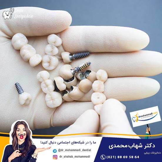 چرا در روز کاشت پایه ایمپلنت دندان، تاج بر روی آن قرار نمی گیرد؟ - کلینیک دندانپزشکی دکتر شهاب محمدی