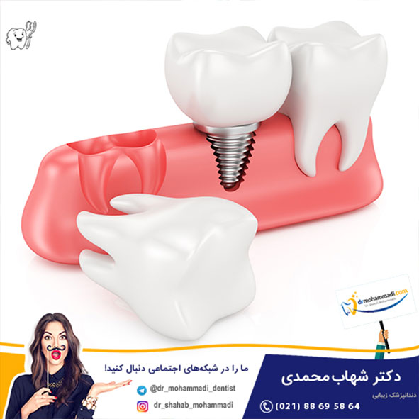 باید های مراقبت از بخیه های لثه بعد از کاشت ایمپلنت دندان (قرار دادن فیکسچر) چیست؟ - کلینیک دندانپزشکی دکتر شهاب محمدی