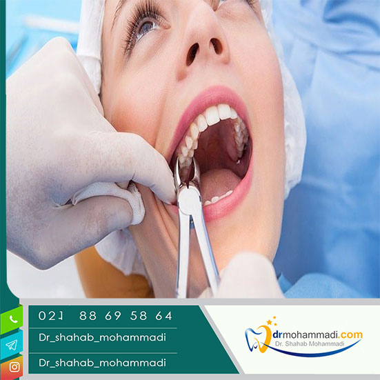 چه مدت بعد از کشیدن دندان باید ایمپلنت کرد؟ - کلینیک دندانپزشکی دکتر شهاب محمدی