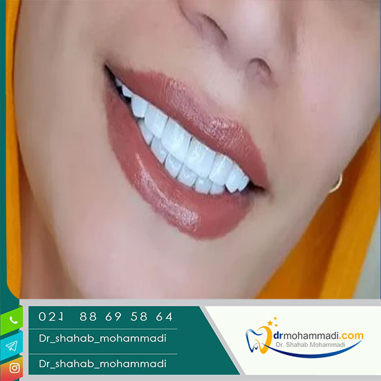 هر واحد دندان یعنی چه و چه تاثیری در قیمت ونیر دندان دارد؟ - کلینیک دندانپزشکی دکتر شهاب محمدی