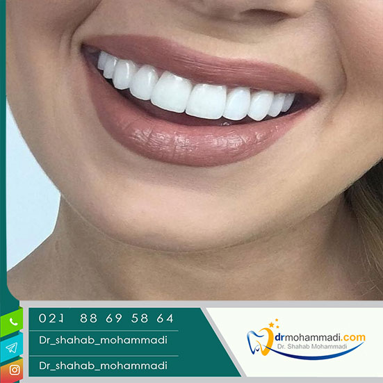 بهترین مارک لیمنت دندان - کلینیک دندانپزشکی دکتر شهاب محمدی
