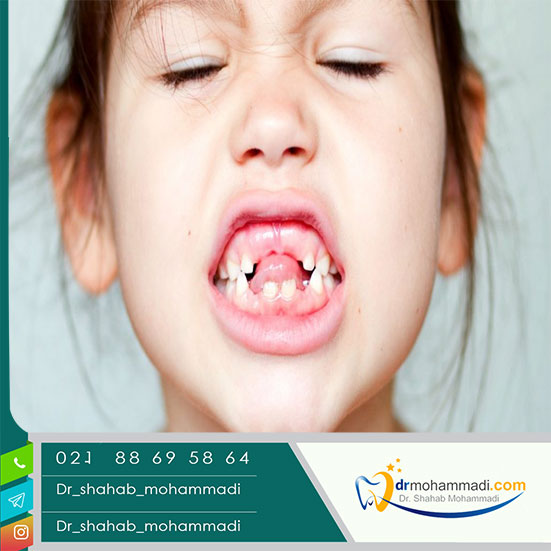 شکستگی دندان های شیری و اثرات آن روی دندان های دائمی