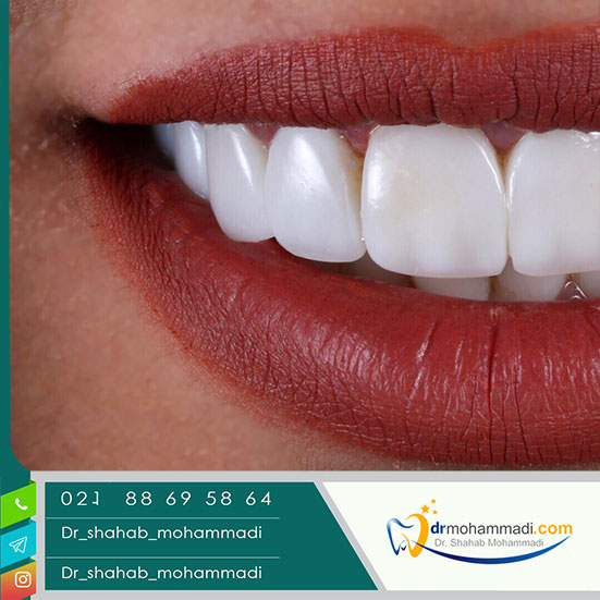 فرق لمینت و کامپوزیت دندان در چیست؟ - کلینیک دندانپزشکی دکتر شهاب محمدی