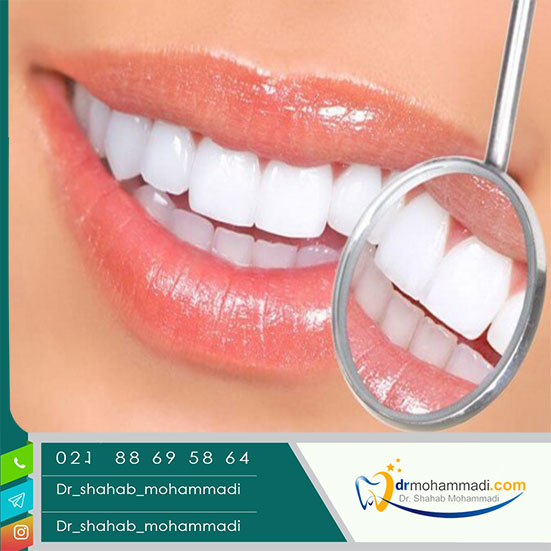 کامپوزیت دندان سوئیسی و مقایسه آنها با انواع کامپوزیت دندان آلمانی  - کلینیک دندانپزشکی دکتر شهاب محمدی