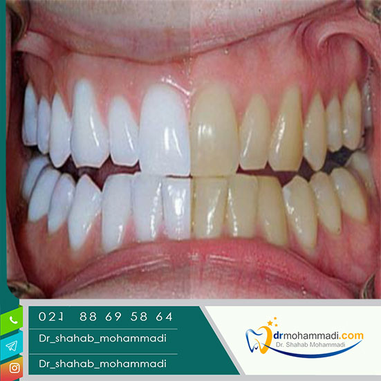 آیا عوارض بلیچینگ دندان نگران کننده است؟ - کلینیک دندانپزشکی دکتر شهاب محمدی