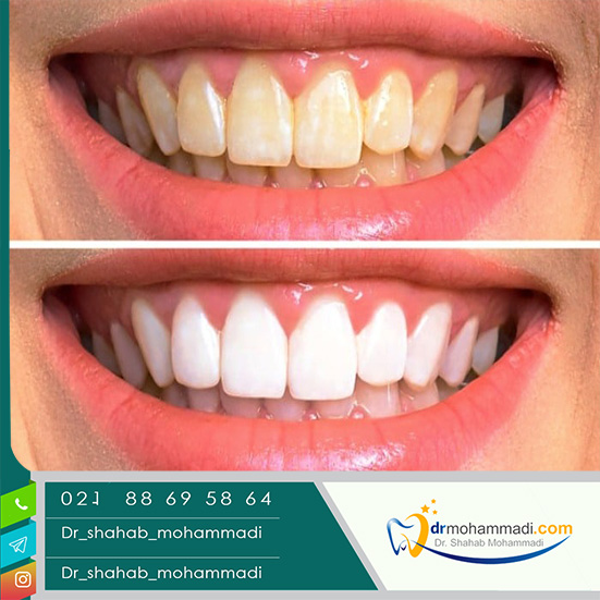 با چه روش هایی می توان زردی دندان را از بین برد؟ - کلینیک دندانپزشکی دکتر شهاب محمدی