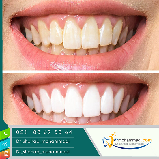 قیمت بلیچینگ یا سفید کردن دندان ها چقدر است؟ - کلینیک دندانپزشکی دکتر شهاب محمدی