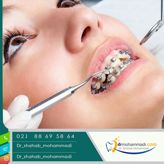 مراحل ارتودنسی دوفک به ترتیب! - کلینیک دندانپزشکی دکتر شهاب محمدی