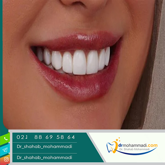 عوارض بلیچینگ دندان چیست؟- کلینیک دندانپزشکی دکتر شهاب محمدی