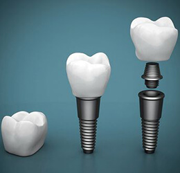 عوامل شل شدن و خرابی ریشه ایمپلنت دندان چیست؟ - کلینیک دندانپزشکی دکتر شهاب محمدی