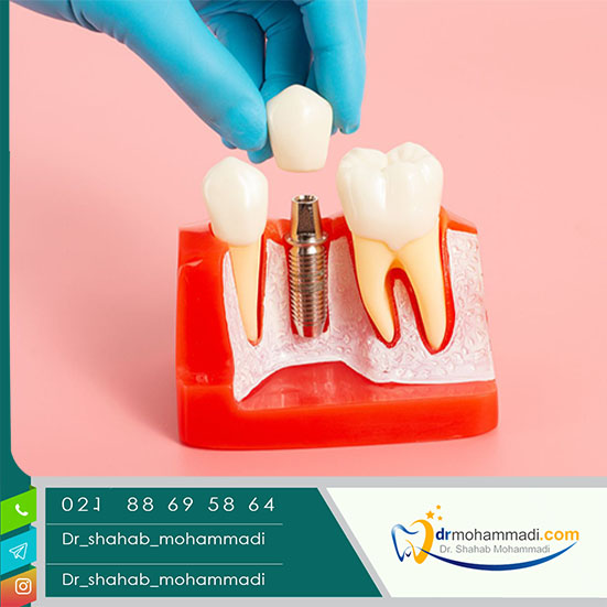 ایمپلنت دندان چه تاثیری روی جویدن دارد؟