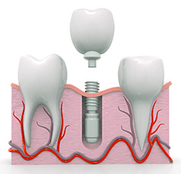 رفتار ایمپلنت در کنار دندان طبیعی - کلینیک دندانپزشکی دکتر شهاب محمدی