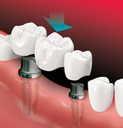بریج و یا پلِ دندان چیست؟ - کلینیک دندانپزشکی دکتر شهاب محمدی