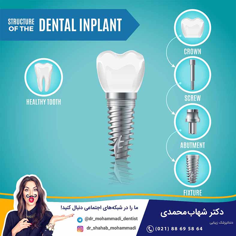 ایمپلنت یا کاشت دندان - کلینیک دندانپزشکی دکتر شهاب محمدی