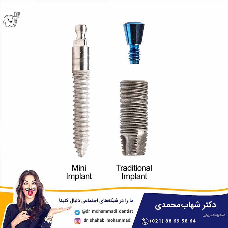 کاشت دندان به روش مینی ایمپلنت (mini implant) - کلینیک دندانپزشکی دکتر شهاب محمدی