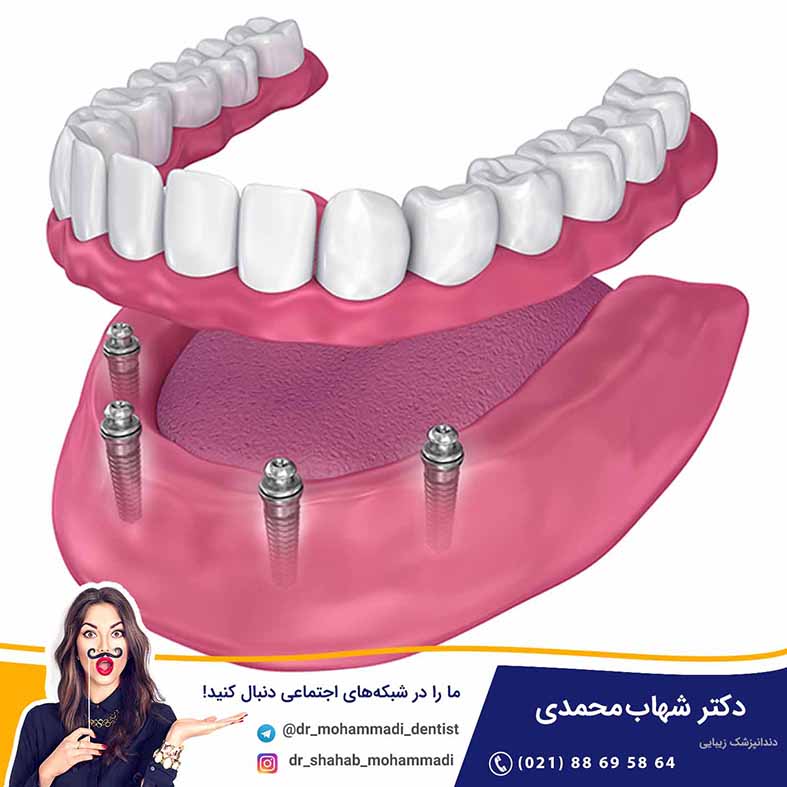 کاشت دندان با تکنیک  All On 4 - کلینیک دندانپزشکی دکتر شهاب محمدی