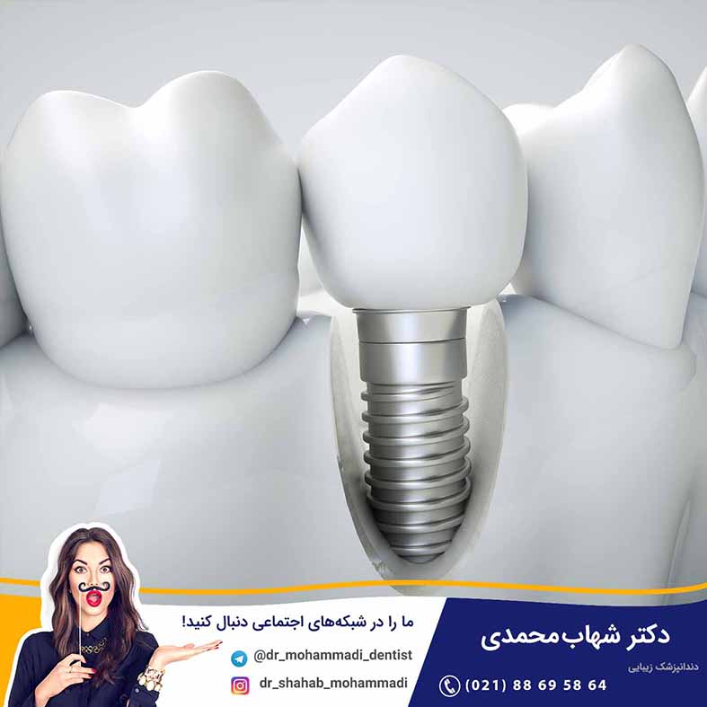 اندازه و ابعاد ایمپلنت دندانی - کلینیک دندانپزشکی دکتر شهاب محمدی