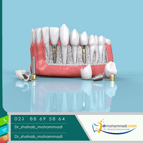 عواقب دیر انجام دادن ایمپلنت دندان چیست؟ - کلینیک دندانپزشکی دکتر شهاب محمدی