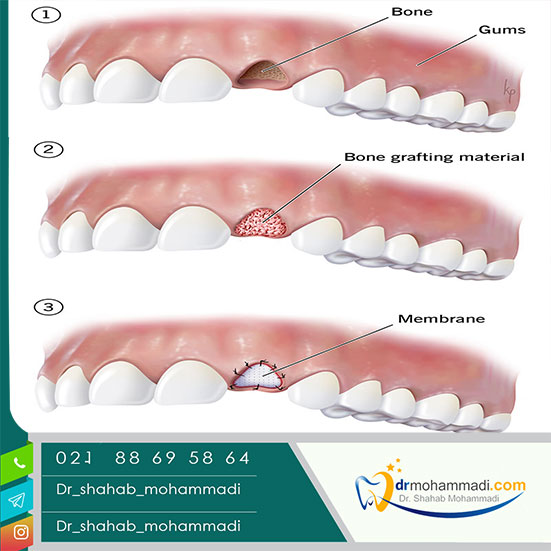 پودر استخوان چیست و چه تاثیری در ایمپلنت دندان دارد؟ - کلینیک دندانپزشکی دکتر شهاب محمدی