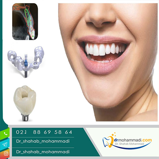 ایمپلنت دندان دیجیتال چیست؟ - کلینیک دندانپزشکی دکتر شهاب محمدی