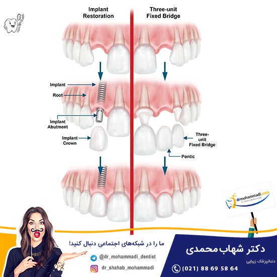 چرا در برخی شرایط دندانپزشک بریج  دندانی را به جای کاشت ایمپلنت پیشنهاد می دهد؟ - کلینیک دندانپزشکی دکتر شهاب محمدی