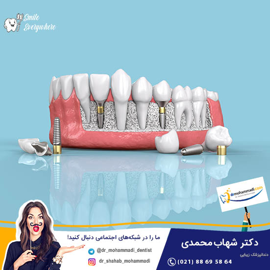 در چه شرایطی  توصیه می شود که یک دندان کشیده شود و به جای آن ایمپلنت دندان کاشته شود؟ - کلینیک دندانپزشکی دکتر شهاب محمدی
