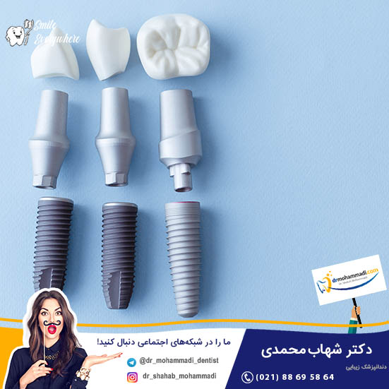 ایمپلنت‌ دندان ایرانی با طراحی و برند داخلی - کلینیک دندانپزشکی دکتر شهاب محمدی