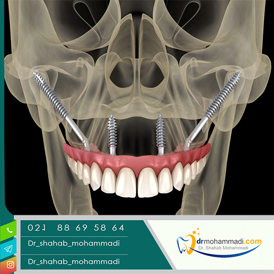 مزیت بیهوشی بیمار در زمان ایمپلنت دندان