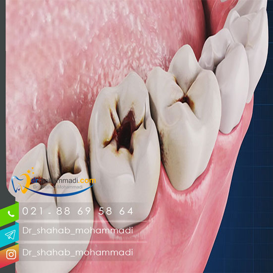 علت بروز سندروم ترک دندان