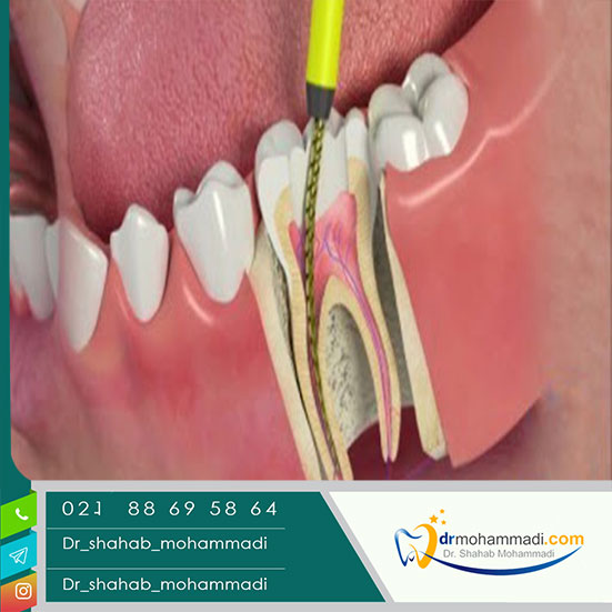 درمان ریشه دندان چه مزایایی دارد؟