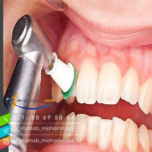 جرم گیری چه نقشی در سلامت دندان دارد؟