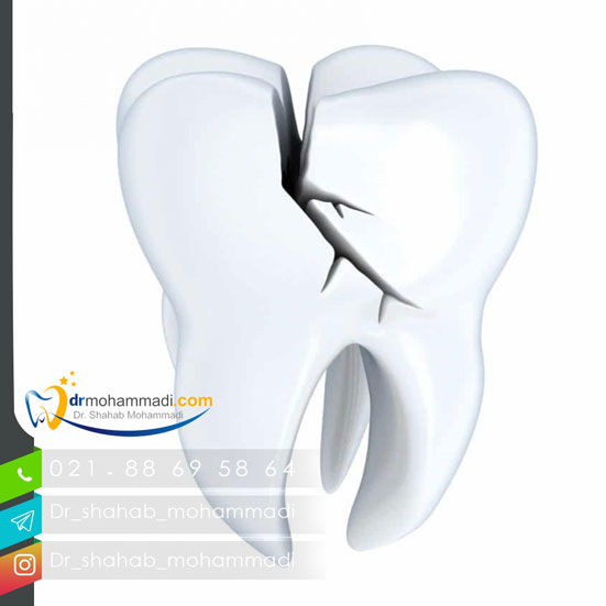 سندروم ترک دندان چیست؟