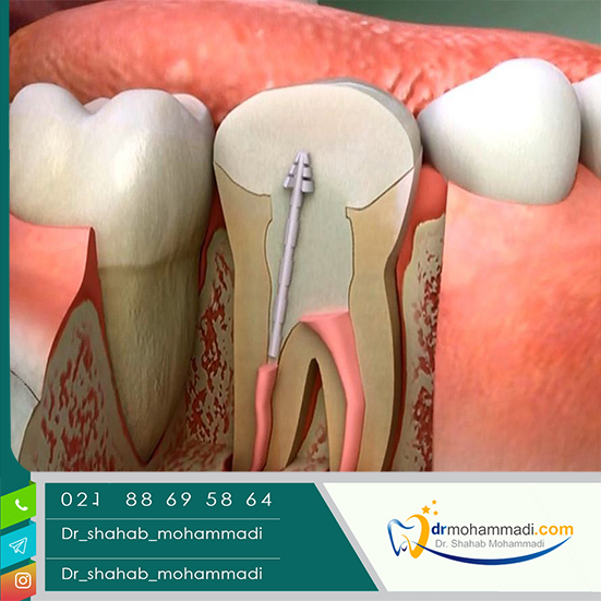 پالپوتومی دندان چیست؟