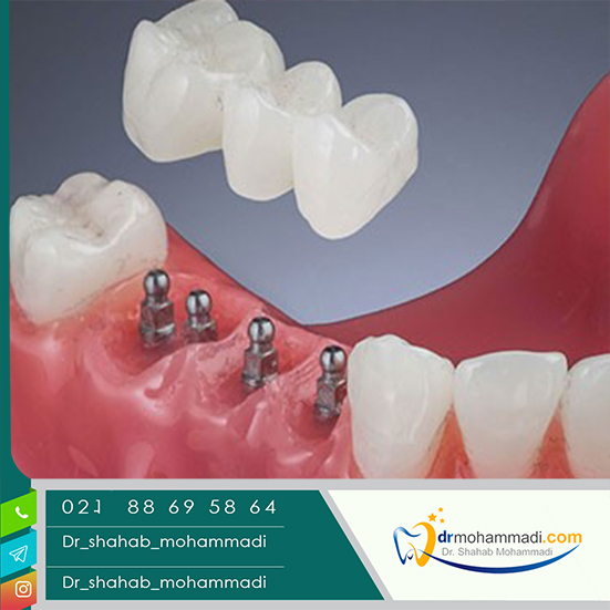 کاشت مینی ایمپلنت برای چه کسانی مناسب است؟ 