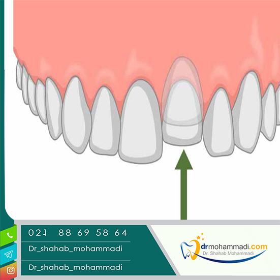 اینتروژن دندان چیست؟