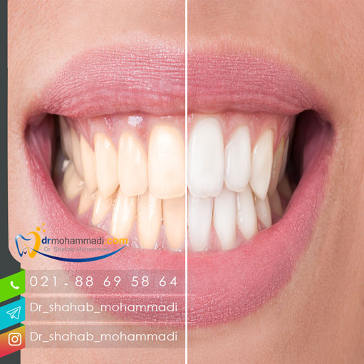 جرم گیری چه نقشی در سلامت دندان دارد؟