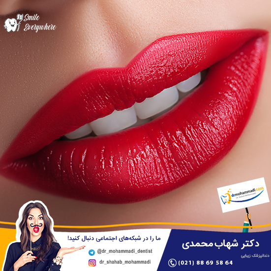 ونیر لمینت