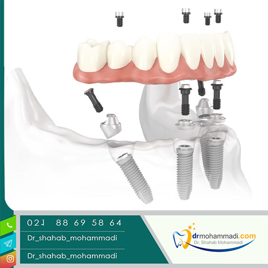 ایمپلنت All on 4 - کلینیک دندانپزشکی دکتر شهاب محمدی