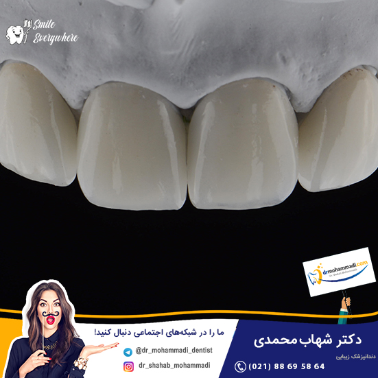 درباره کاربرد روش های مدرن اصلاح طرح لبخند با کامپوزیت دندان بیشتر بدانید